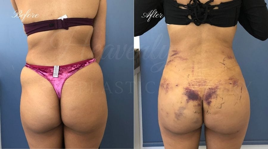 brazilian butt lift procedure brazilian butt lift procedure