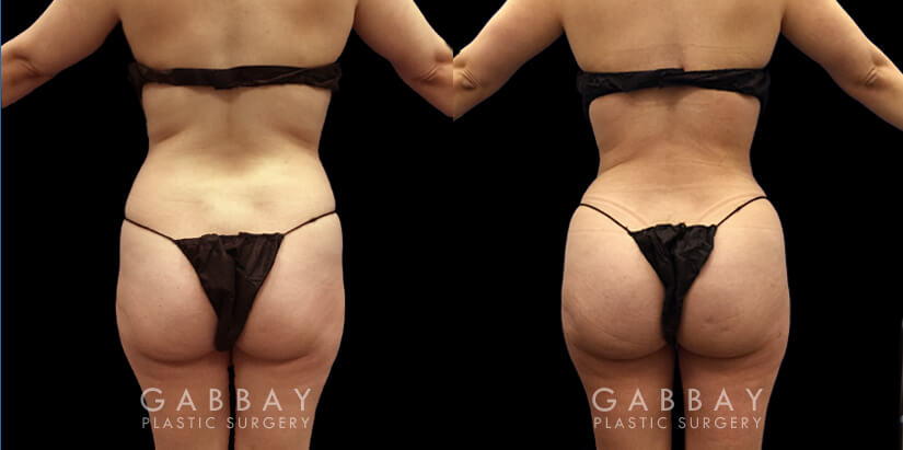 brazilian butt lift procedure brazilian butt lift procedure