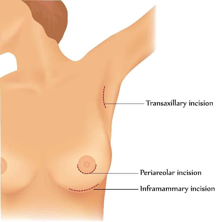 breast aug breast aug