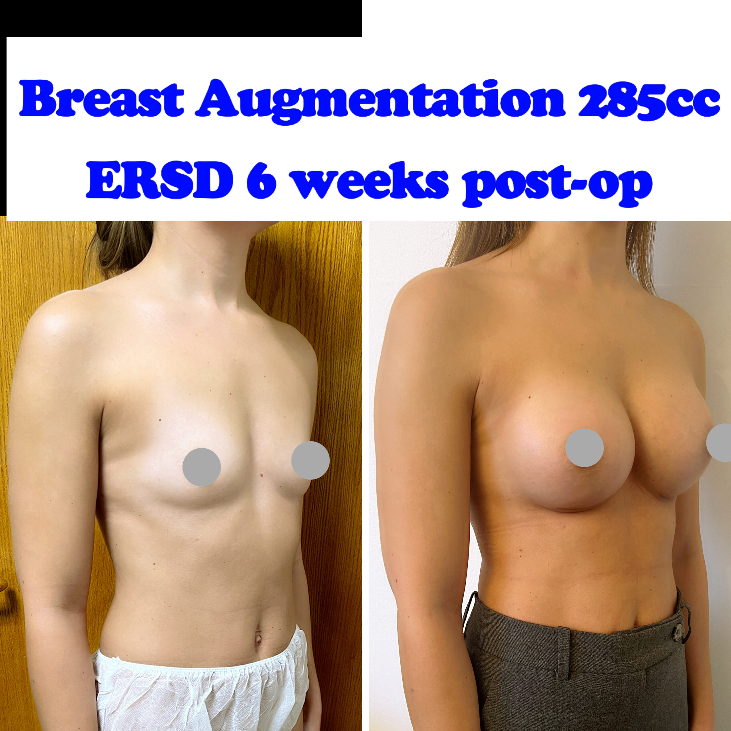 breast enlargement breast enlargement