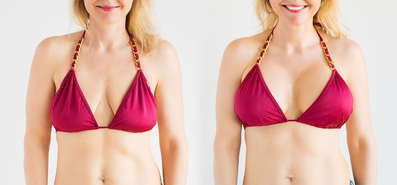 breast enlargement breast enlargement