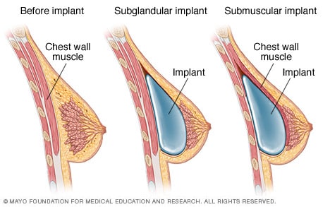 Breast enlargement: Exploring surgical and non-surgical options