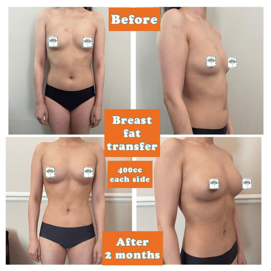 breast enlargement breast enlargement