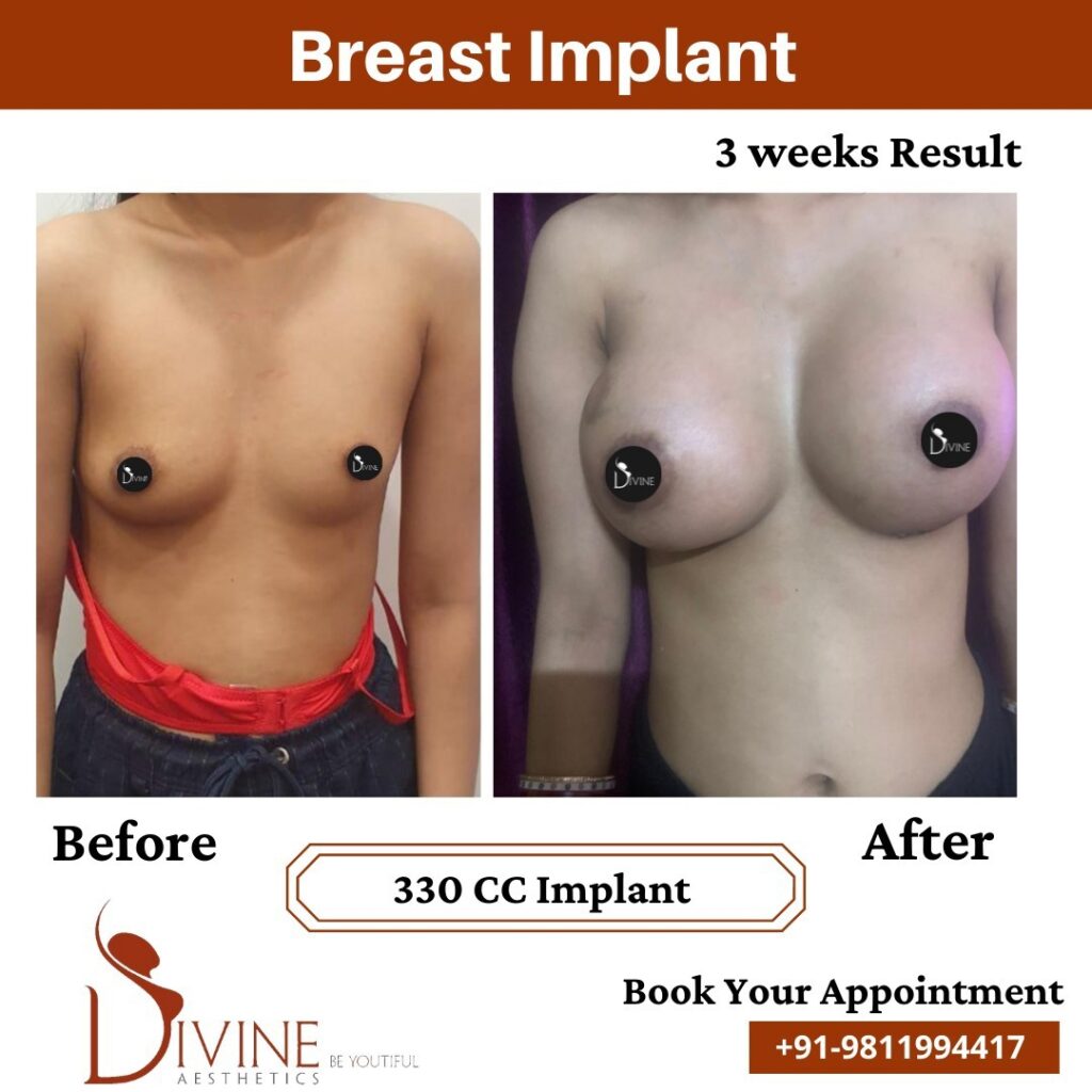 breast enlargement injection price breast enlargement injection price
