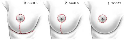 breast enlargement without surgery breast enlargement without surgery