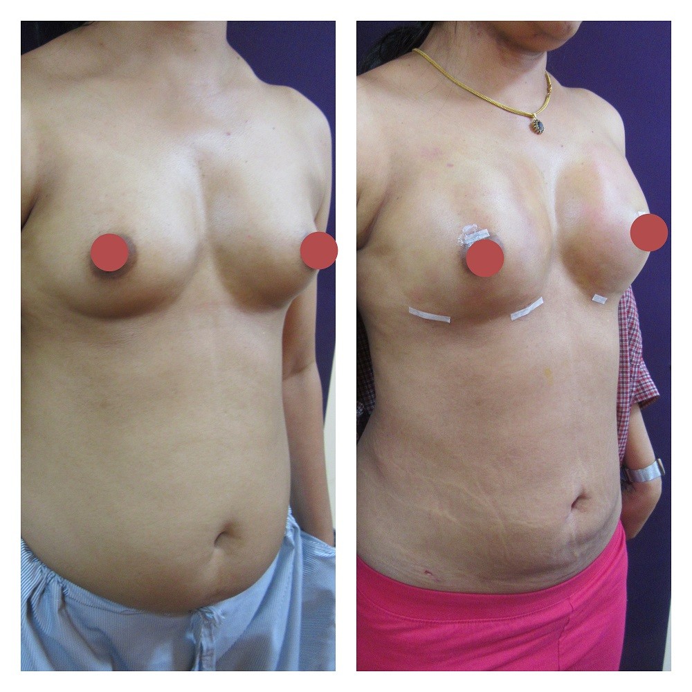 breast fat transfer cost breast fat transfer cost