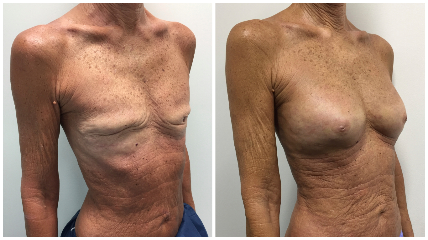 breast fat transfer cost breast fat transfer cost