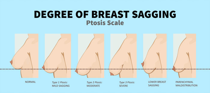 Breast fat transfer cost: Combining natural enhancement with reshaping