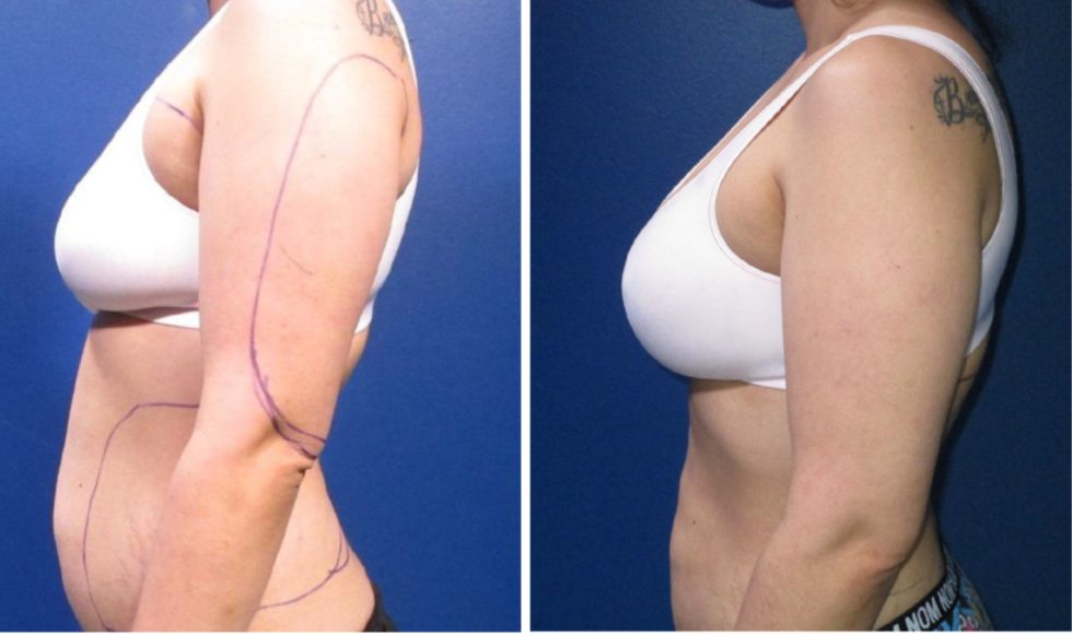 breast fat transfer cost breast fat transfer cost