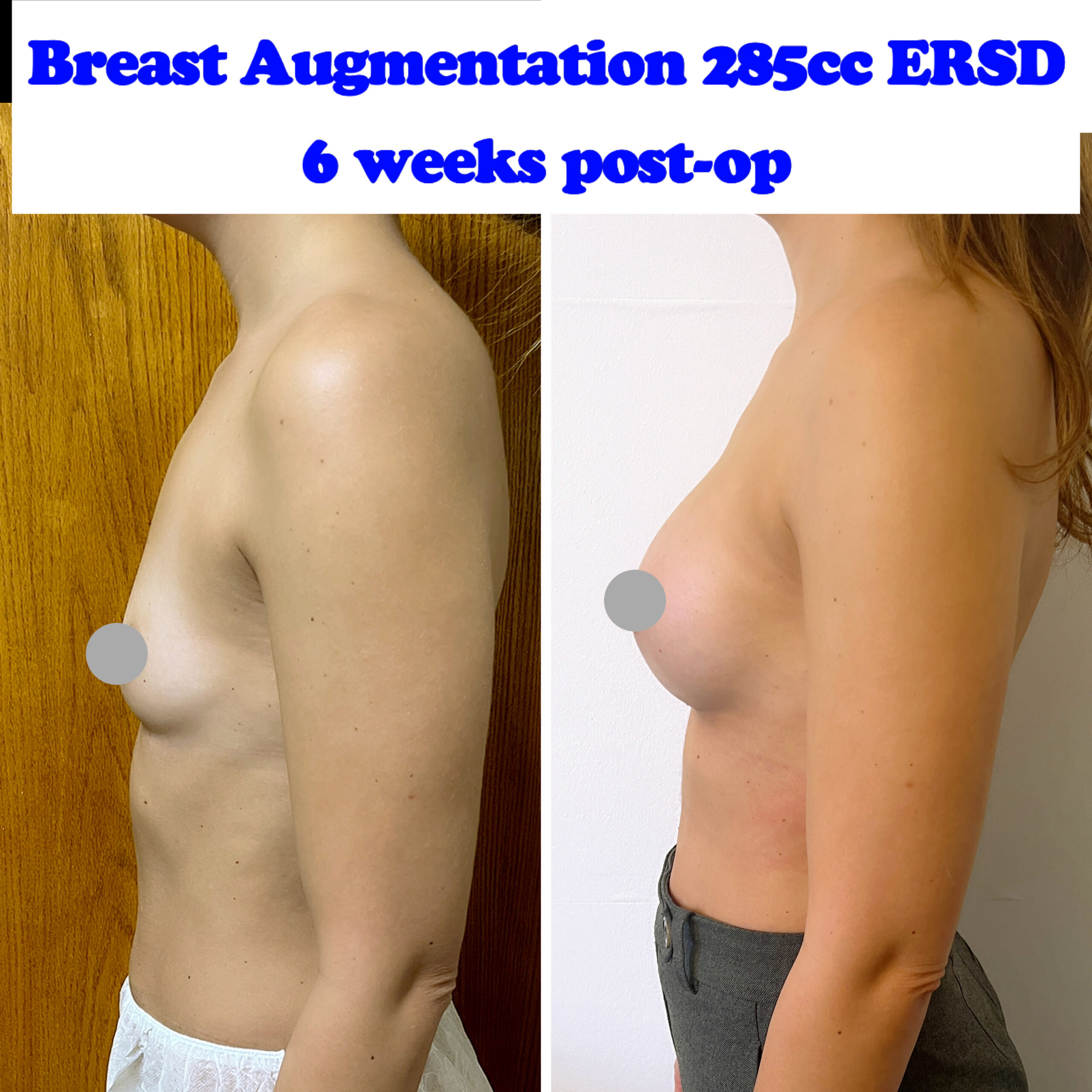 breast implants breast implants