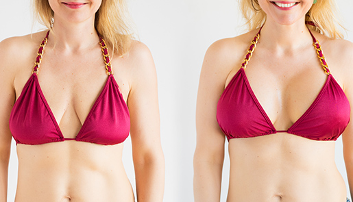 Breast Implants: Options for enhancement