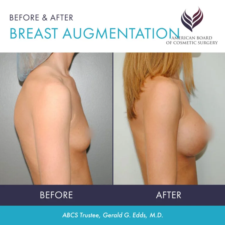 breast implants breast implants