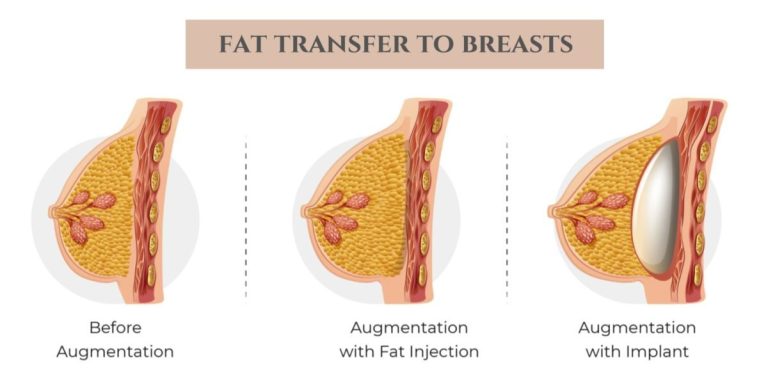 Breast injections: Adding volume through minimally invasive methods