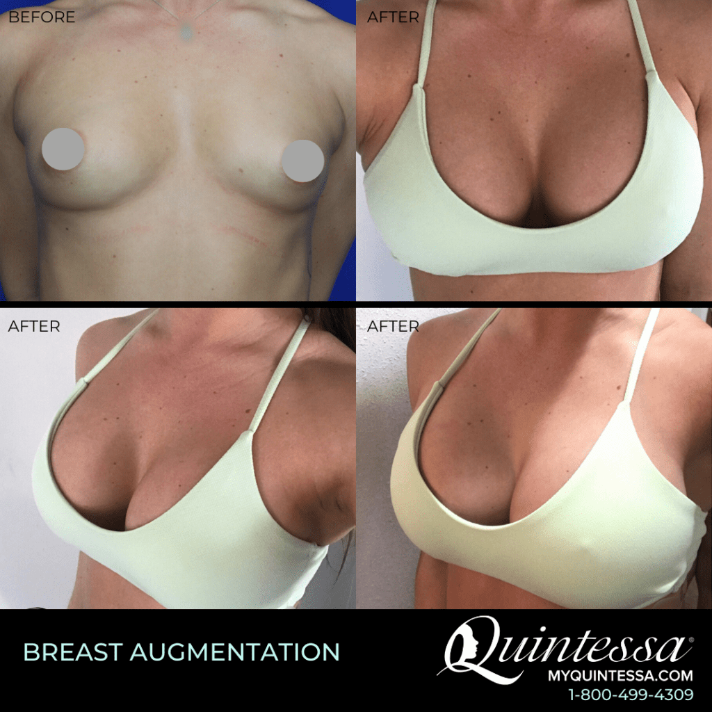 breast injections breast injections