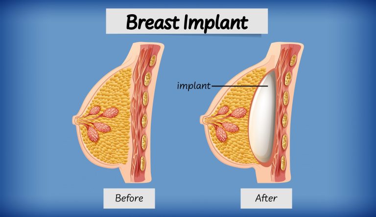 Breast job cost: Key considerations before your procedure