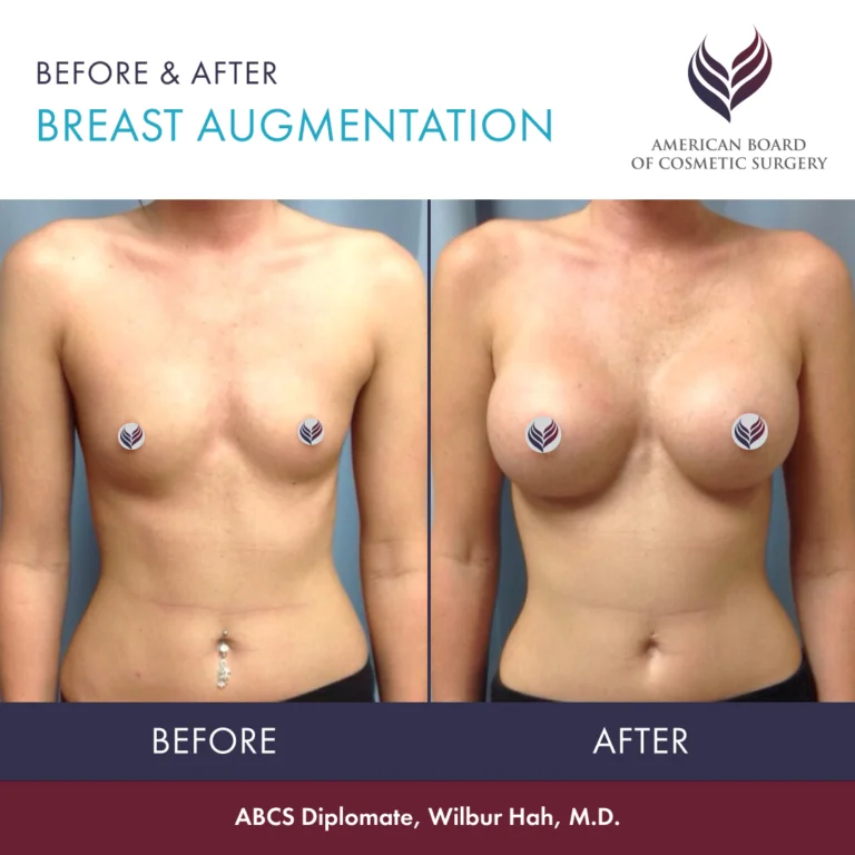 Breast Job: Personalized enhancement