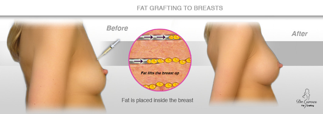 breast lift and fat transfer