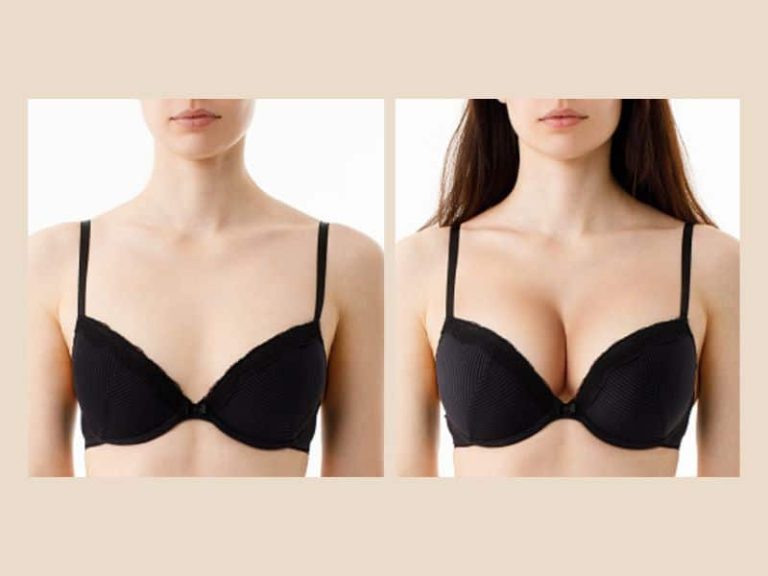 Breast lift and fat transfer: Combining volume and lift for natural results