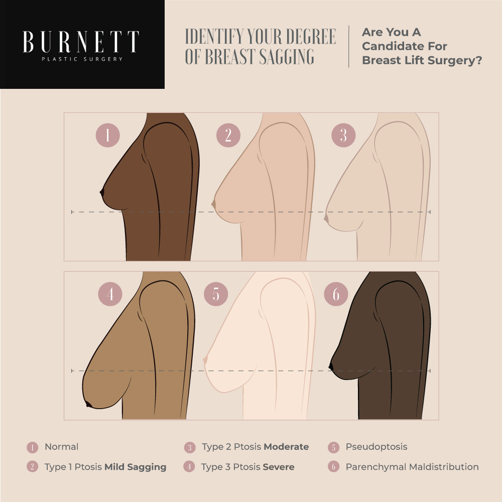 breast lift breast lift