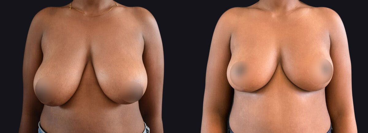 breast lift breast lift
