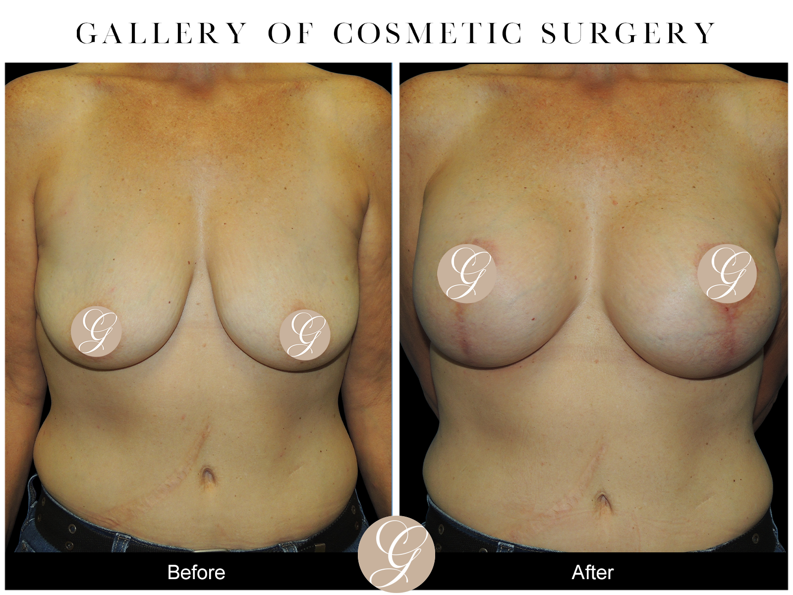 breast lift breast lift