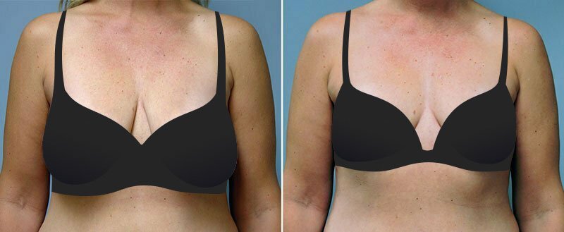 breast lift without surgery