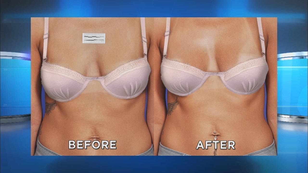breast lift without surgery