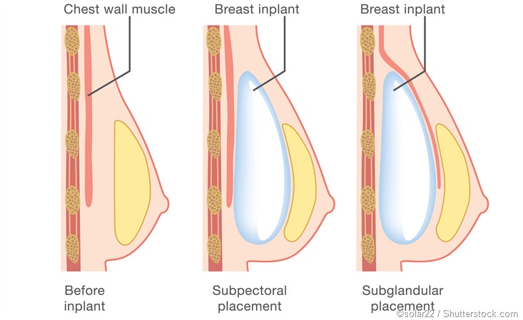Breast Operation: Tailored solutions for your needs