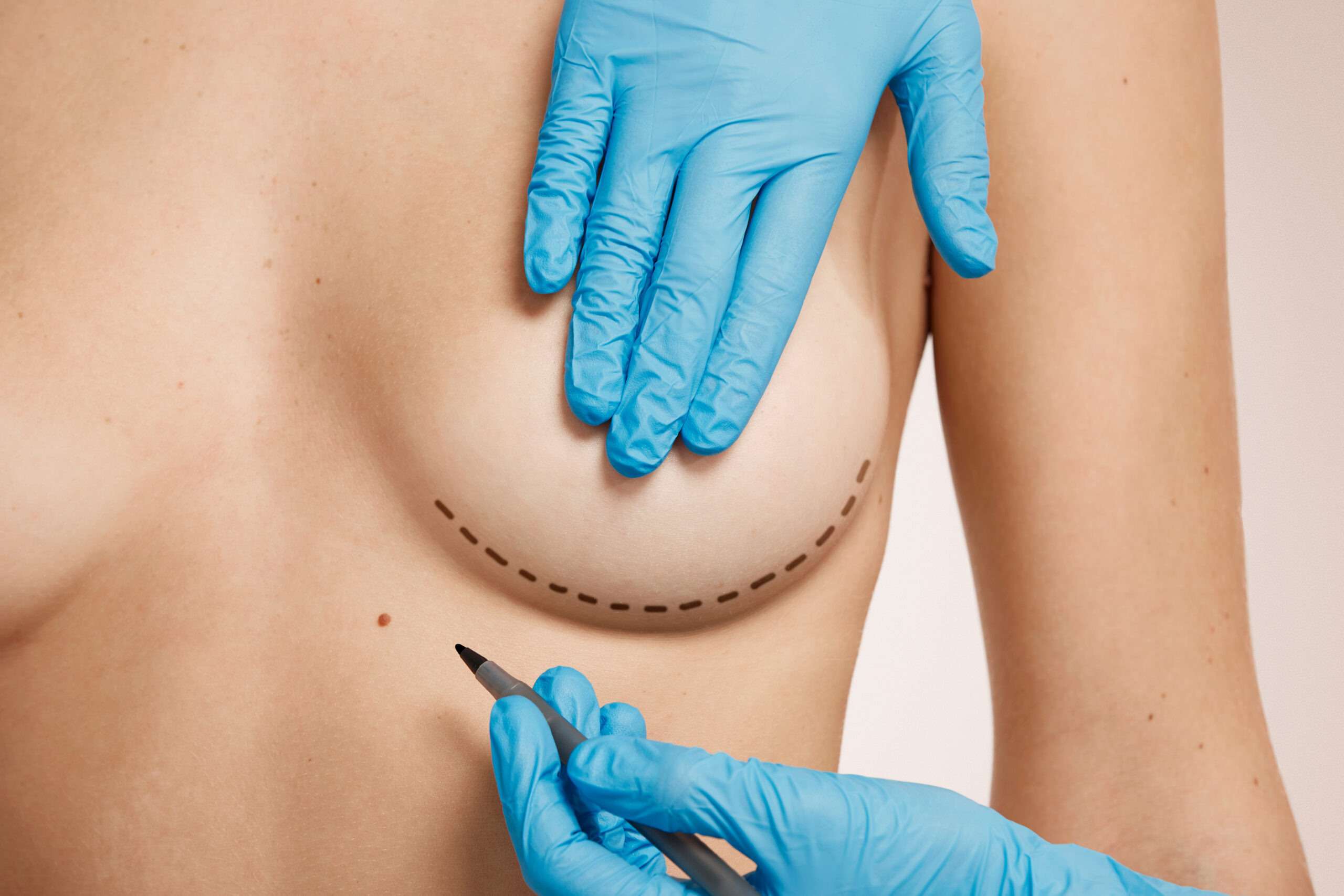 breast plastic surgery breast plastic surgery