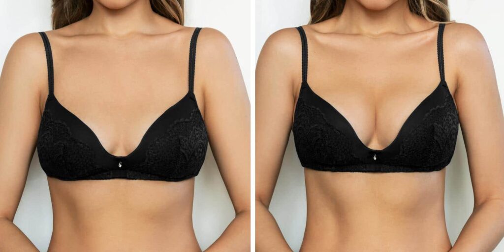 breast plastic surgery breast plastic surgery