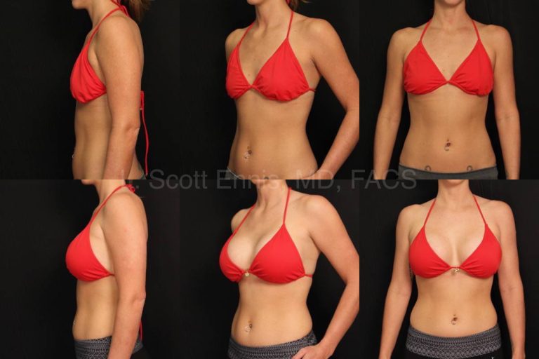 Breast Plastic Surgery: Tailored solutions for every need