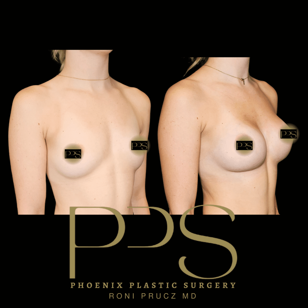 breast plastic surgery breast plastic surgery