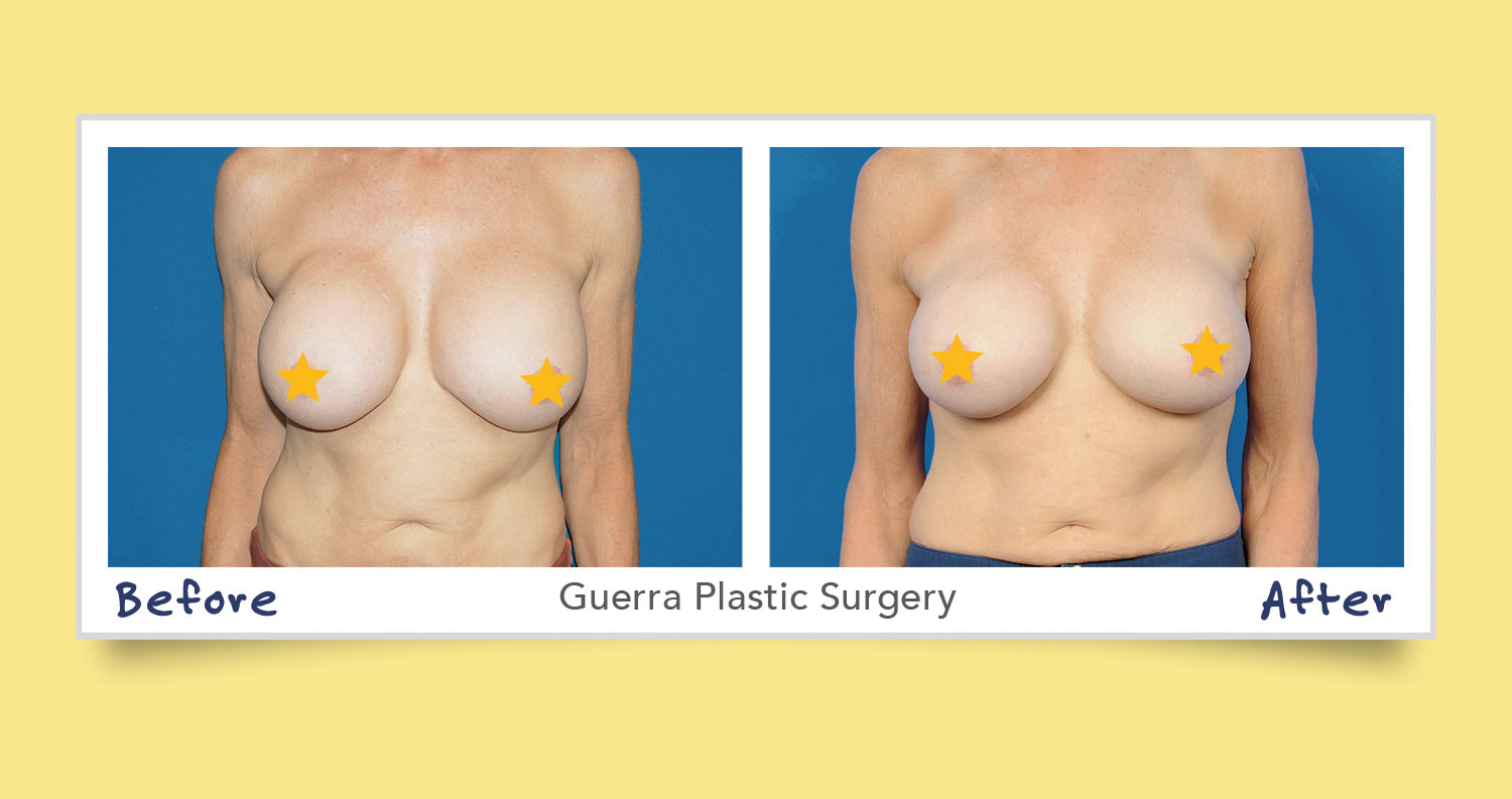 breast revision