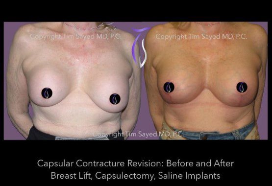 breast revision