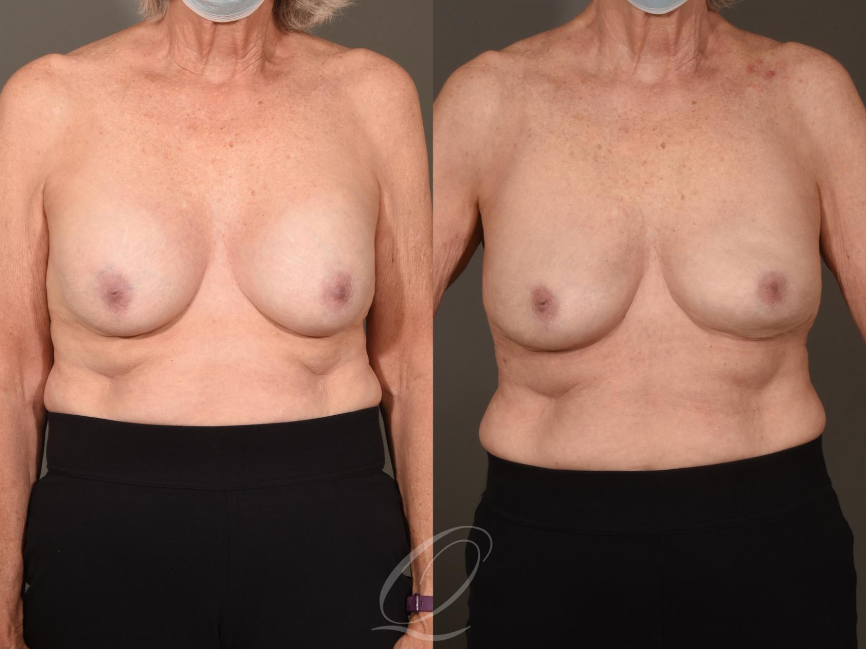 breast revision