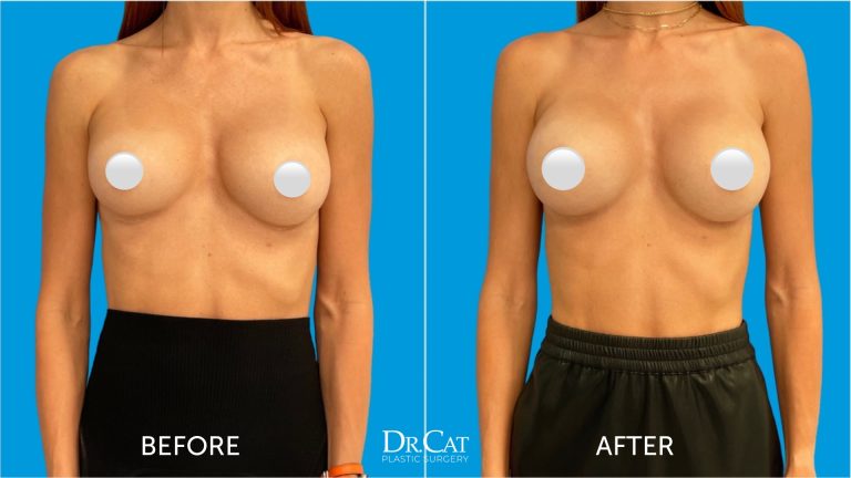 Breast Revision: Enhancing or correcting previous results