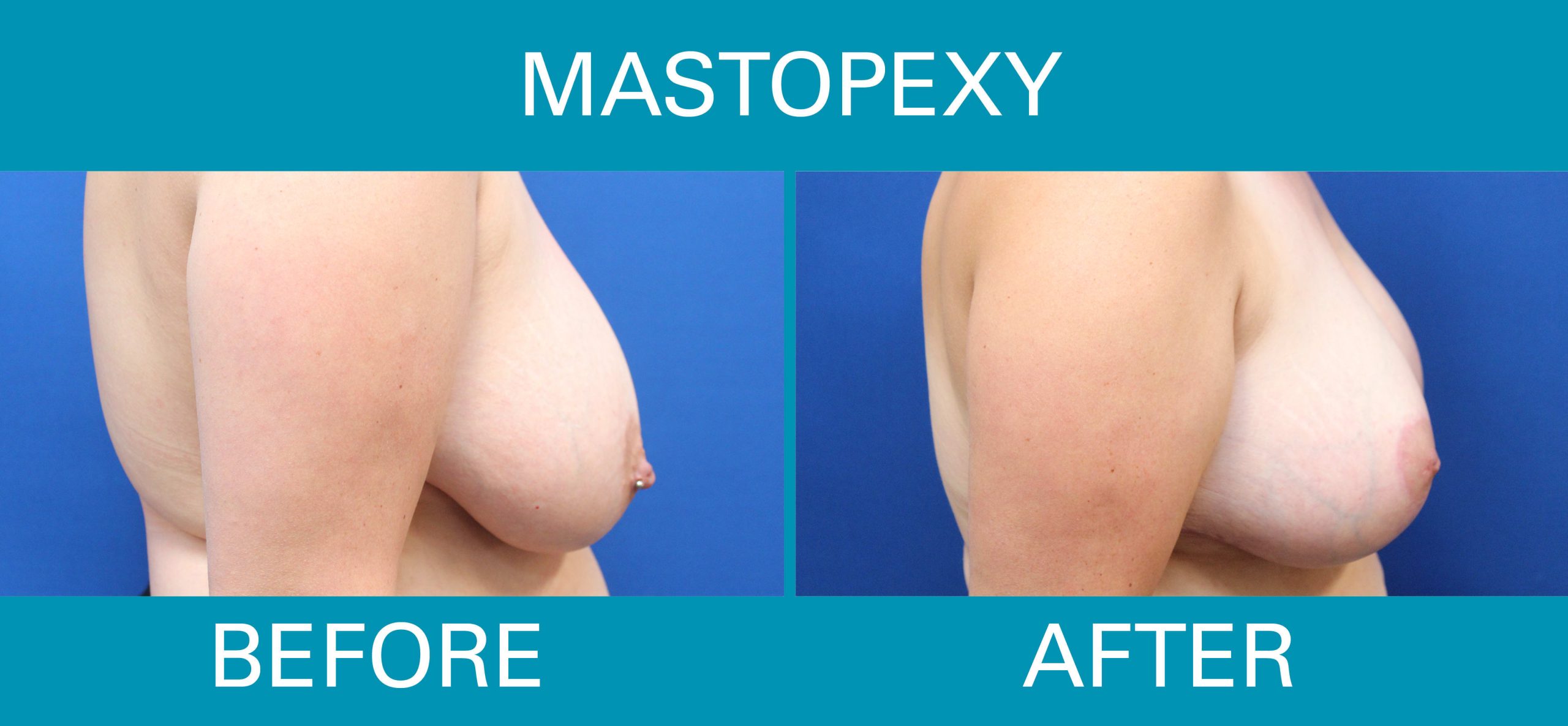 breast uplift breast uplift