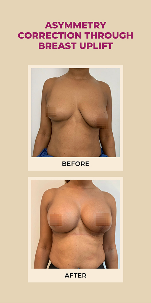 breast uplift breast uplift