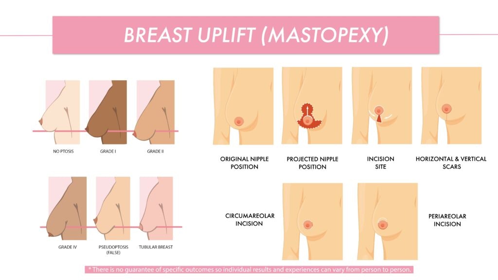 breast uplift breast uplift