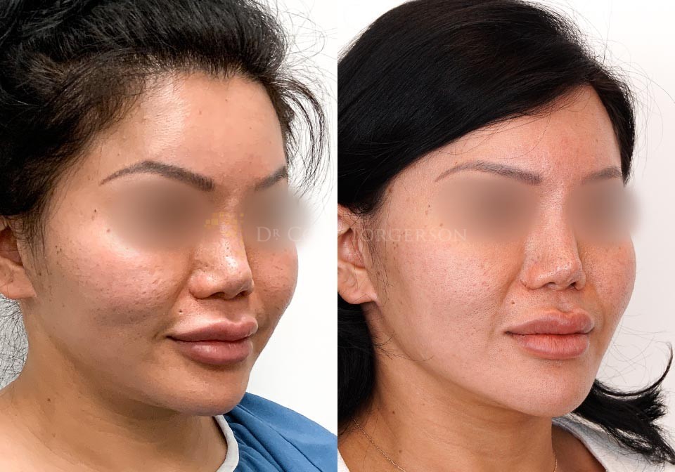 buccal fat reduction buccal fat reduction