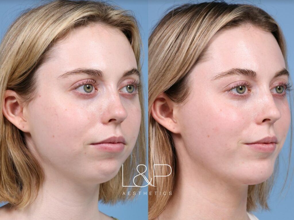 buccal fat reduction buccal fat reduction