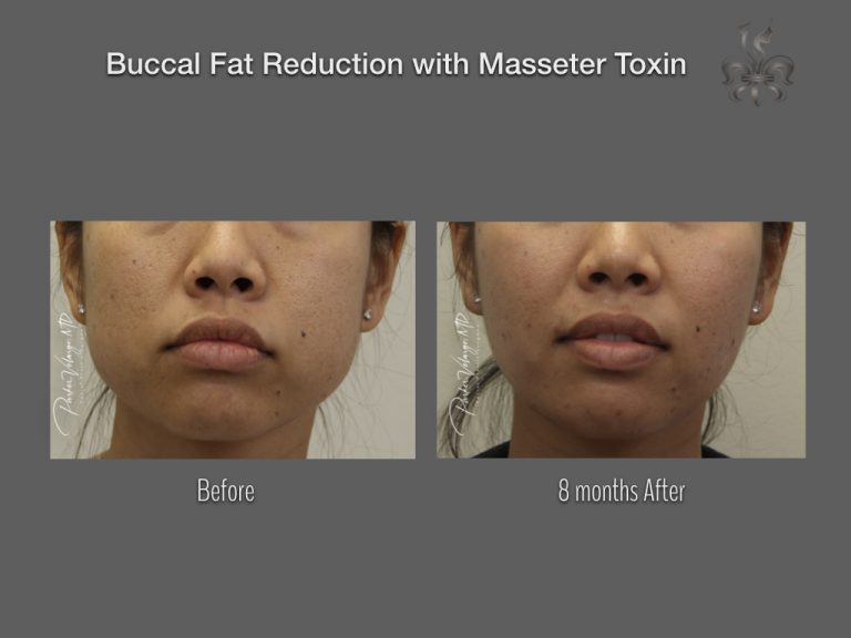 buccal fat reduction buccal fat reduction
