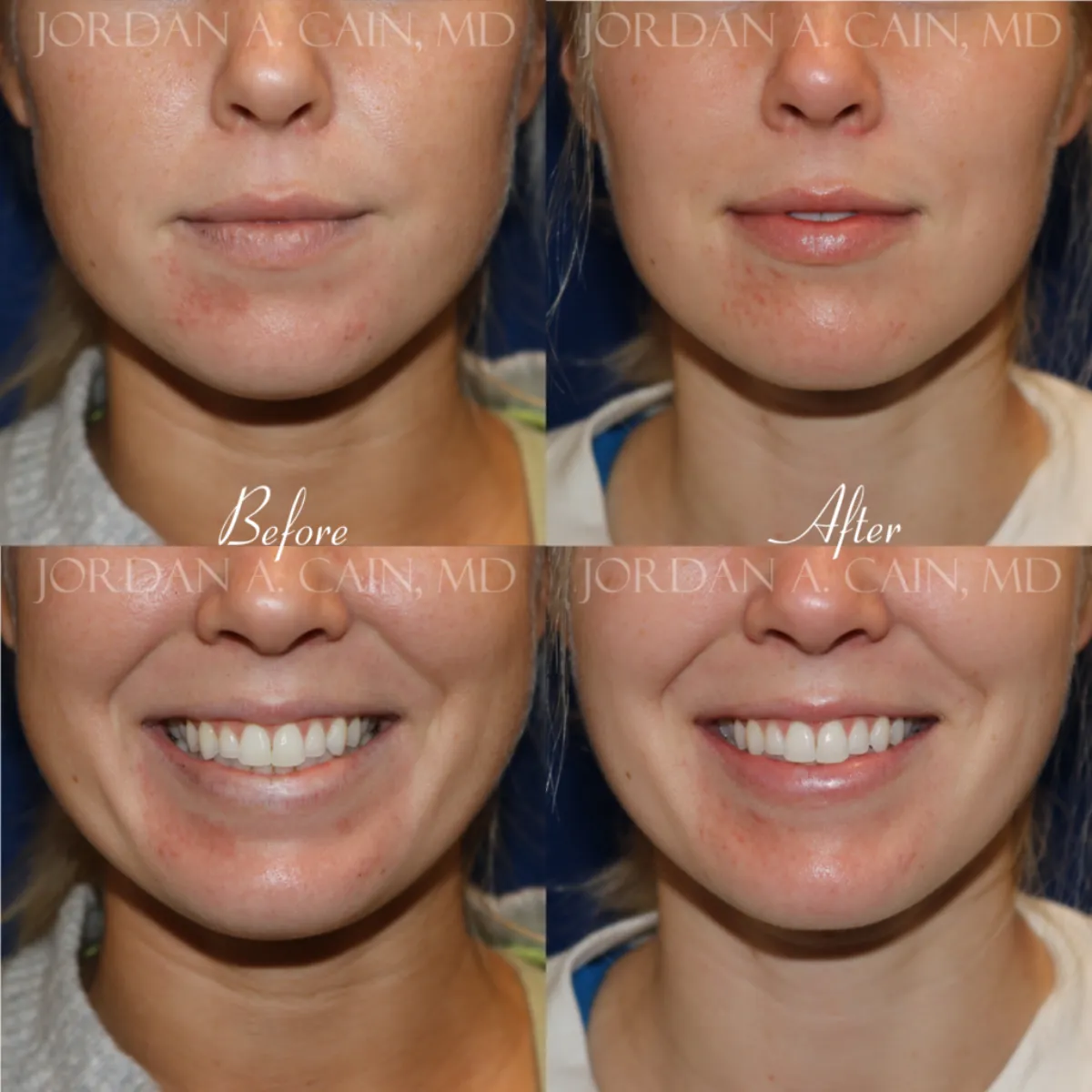 buccal fat reduction buccal fat reduction