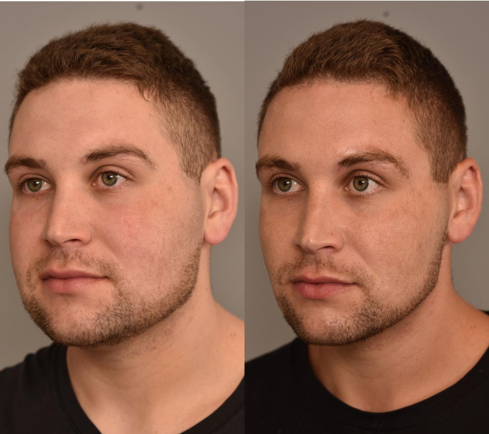 buccal fat removal buccal fat removal