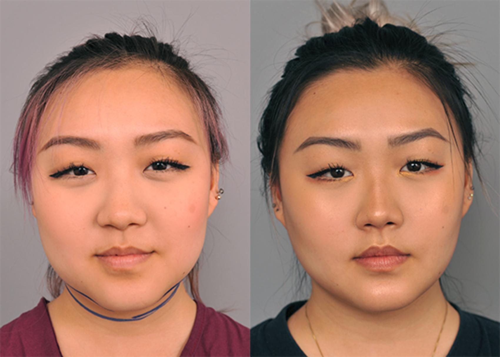 buccal fat removal cost buccal fat removal cost