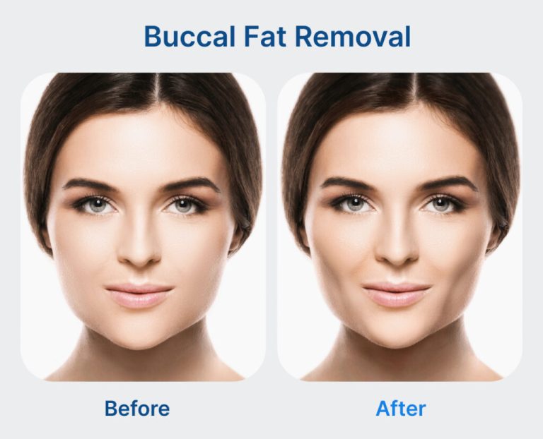 Buccal fat removal cost: Understanding the price of facial contouring