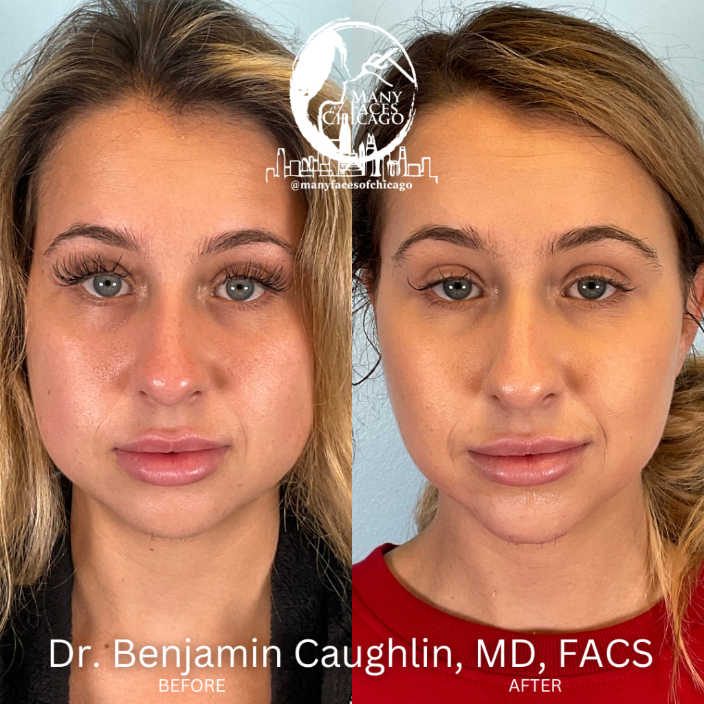 buccal fat removal cost buccal fat removal cost