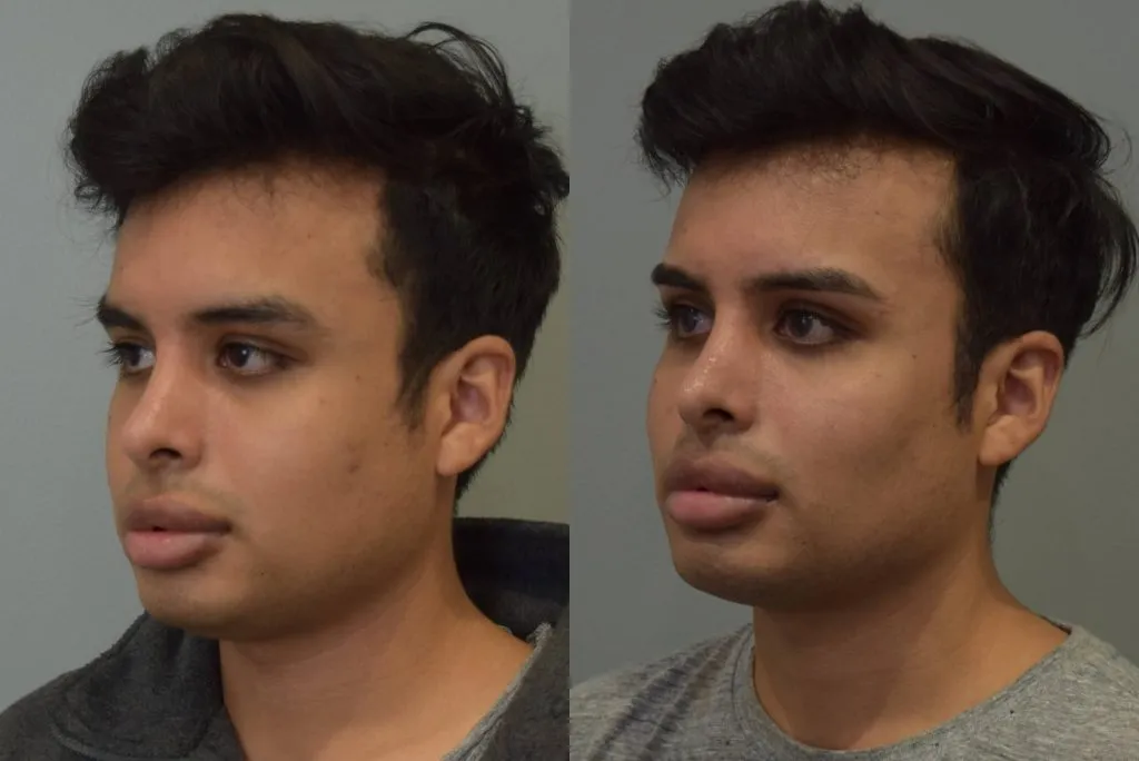 buccal fat removal men buccal fat removal men
