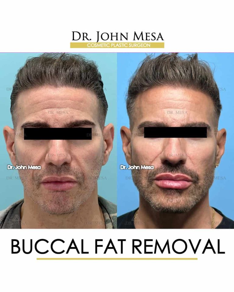 Buccal Fat Removal Men: Contouring for a chiseled look