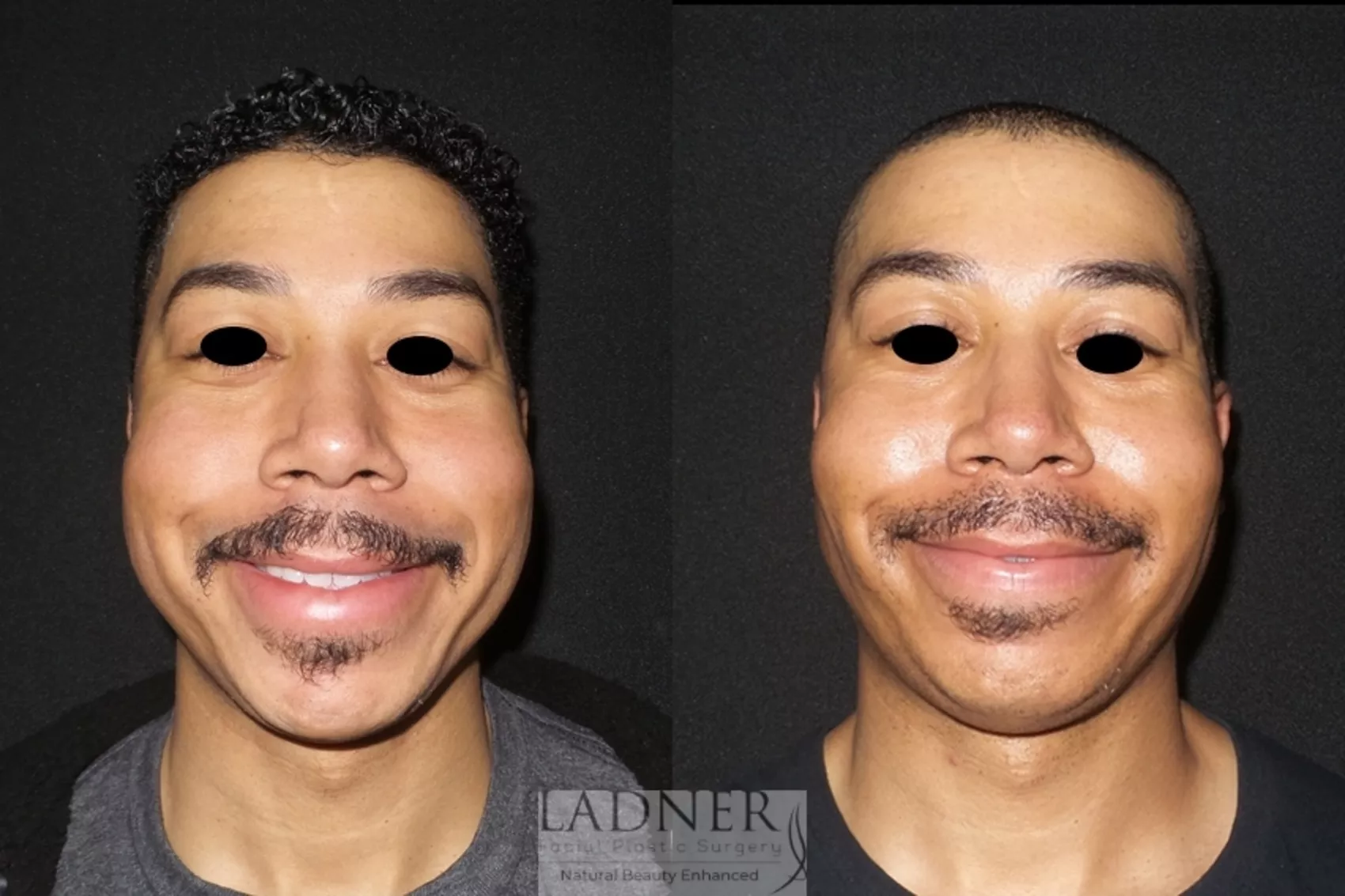 buccal fat removal men buccal fat removal men